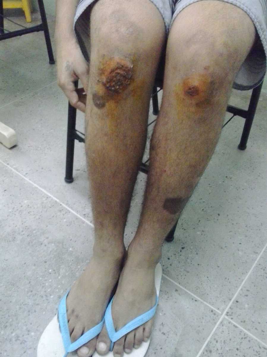 Adolescente internado em uma das unidades do Sistema Socioeducativo do Ceará apresenta ferimentos nos joelhos, supostamente em decorrência de tortura e tratamento cruel